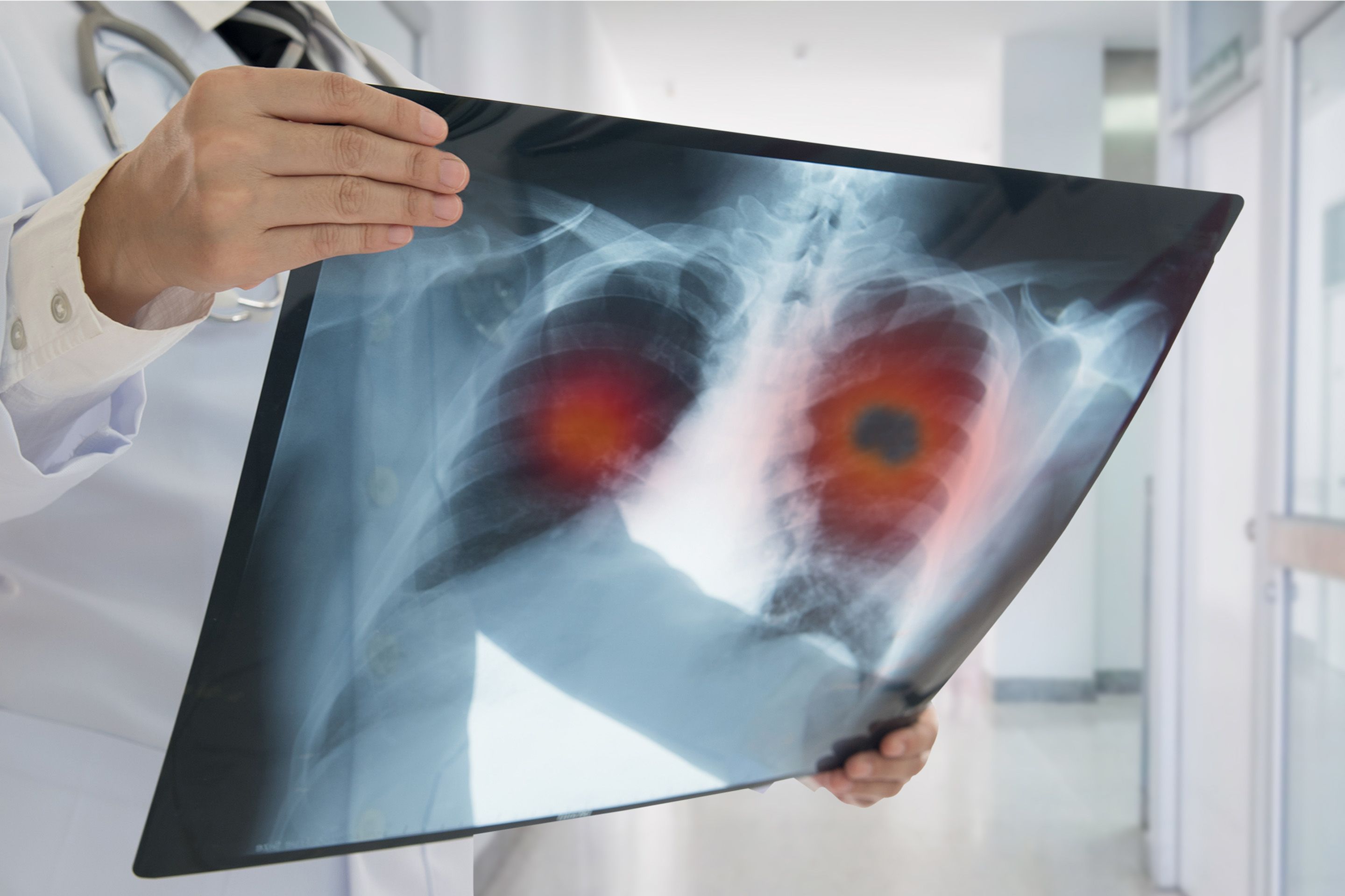 Chest X-ray with two highlighted red areas in the lung region
